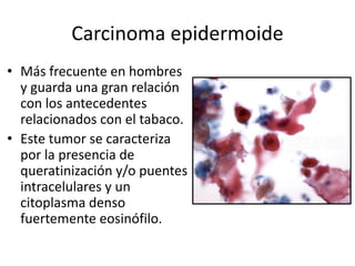 Carcinoma epidermoide
• Más frecuente en hombres
y guarda una gran relación
con los antecedentes
relacionados con el tabaco.
• Este tumor se caracteriza
por la presencia de
queratinización y/o puentes
intracelulares y un
citoplasma denso
fuertemente eosinófilo.
 