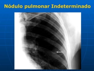 Nódulo pulmonar Indeterminado 