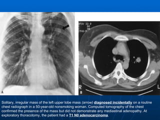 Solitary, irregular mass of the left upper lobe mass  (arrow)   diagnosed incidentally  on a routine chest radiograph in a 50-year-old nonsmoking woman. Computed tomography of the chest confirmed the presence of the mass but did not demonstrate any mediastinal adenopathy. At exploratory thoracotomy, the patient had a  T1 N0 adenocarcinoma .  
