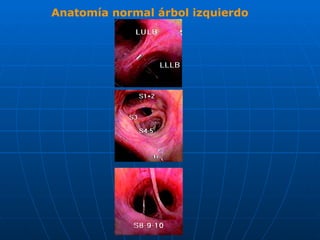 Anatomía normal árbol izquierdo 