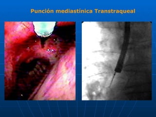 Punción mediastínica Transtraqueal 