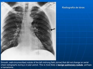 Radiografía de tórax




Smooth, well-circumscribed nodule of the left mid-lung field (arrow) that did not change on serial
chest radiographs during a 2-year period. This is most likely a benign pulmonary nodule, perhaps
a hamartoma.
 
