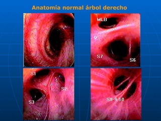Anatomía normal árbol derecho
 
