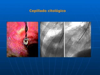 Cepillado citológico
 