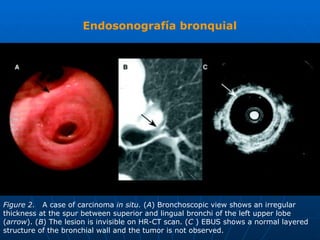 Endosonografía bronquial




Figure 2. A case of carcinoma in situ. (A) Bronchoscopic view shows an irregular
thickness at the spur between superior and lingual bronchi of the left upper lobe
(arrow). (B) The lesion is invisible on HR-CT scan. (C ) EBUS shows a normal layered
structure of the bronchial wall and the tumor is not observed.
 