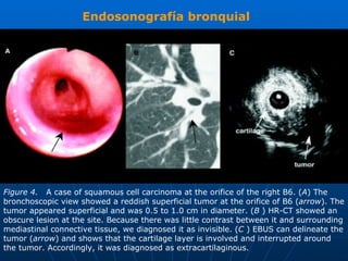 Endosonografía bronquial




Figure 4. A case of squamous cell carcinoma at the orifice of the right B6. (A) The
bronchoscopic view showed a reddish superficial tumor at the orifice of B6 (arrow). The
tumor appeared superficial and was 0.5 to 1.0 cm in diameter. (B ) HR-CT showed an
obscure lesion at the site. Because there was little contrast between it and surrounding
mediastinal connective tissue, we diagnosed it as invisible. (C ) EBUS can delineate the
tumor (arrow) and shows that the cartilage layer is involved and interrupted around
the tumor. Accordingly, it was diagnosed as extracartilaginous.
 