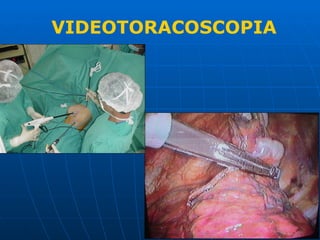 VIDEOTORACOSCOPIA
 