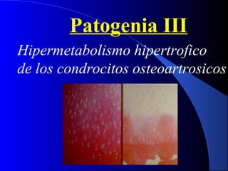 Artrosis de Cadera | PPS