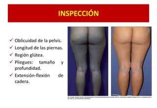 INSPECCIÓN
 Oblicuidad de la pelvis.
 Longitud de las piernas.
 Región glútea.
 Pliegues: tamaño y
profundidad.
 Extensión-flexión de
cadera.
 