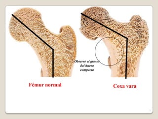 Fémur normal Coxa vara
5
Observe el grosor
del hueso
compacto
 