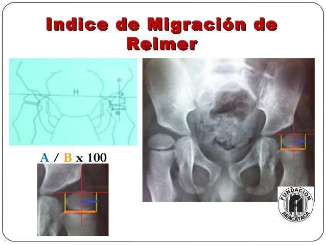 Cadera en pci