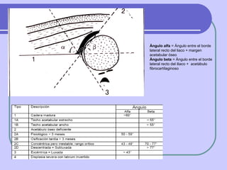Ángulo alfa  = Ángulo entre el borde lateral recto del liaco + margen acetabular óseo  Ángulo beta  = Ángulo entre el borde lateral recto del iliaco +  acetábulo fibrocartílaginoso 