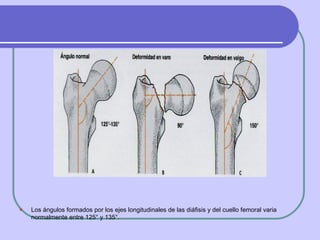 <ul><li>Los ángulos formados por los ejes longitudinales de las diáfisis y del cuello femoral varia normalmente entre 125°...