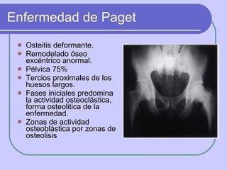 Enfermedad de Paget <ul><li>Osteitis deformante. </li></ul><ul><li>Remodelado óseo excéntrico anormal.  </li></ul><ul><li>...