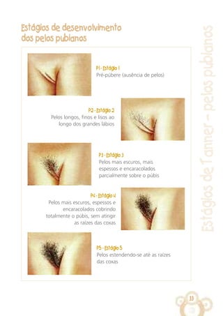 33
EstágiosdeTanner–pelospubianos
Estágios de desenvolvimento
dos pelos pubianos
P1 - Estágio 1
Pré-púbere (ausência de pelos)
P2 - Estágio 2
Pelos longos, finos e lisos ao
longo dos grandes lábios
P3 - Estágio 3
Pelos mais escuros, mais
espessos e encaracolados
parcialmente sobre o púbis
P4 - Estágio 4
Pelos mais escuros, espessos e
encaracolados cobrindo
totalmente o púbis, sem atingir
as raízes das coxas
P5 - Estágio 5
Pelos estendendo-se até as raízes
das coxas
 