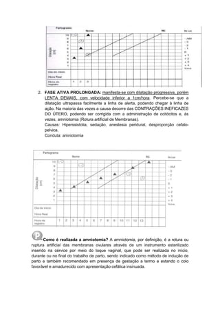 2. FASE ATIVA PROLONGADA: manifesta-se com dilatação progressiva, porém
LENTA DEMAIS, com velocidade inferior a 1cm/hora. Percebe-se que a
dilatação ultrapassa facilmente a linha de alerta, podendo chegar à linha de
ação. Na maioria das vezes a causa decorre das CONTRAÇÕES INEFICAZES
DO ÚTERO, podendo ser corrigida com a administração de ocitócitos e, às
vezes, amniotomia (Rotura artificial de Membranas).
Causas: Hiperssistolia, sedação, anestesia peridural, desproporção cefalo-
pelvica.
Conduta: amniotomia
Como é realizada a amniotomia? A amniotomia, por definição, é a rotura ou
ruptura artificial das membranas ovulares através de um instrumento esterilizado
inserido na cérvice por meio do toque vaginal, que pode ser realizada no início,
durante ou no final do trabalho de parto, sendo indicado como método de indução de
parto e também recomendado em presença de gestação a termo e estando o colo
favorável e amadurecido com apresentação cefálica insinuada.
 