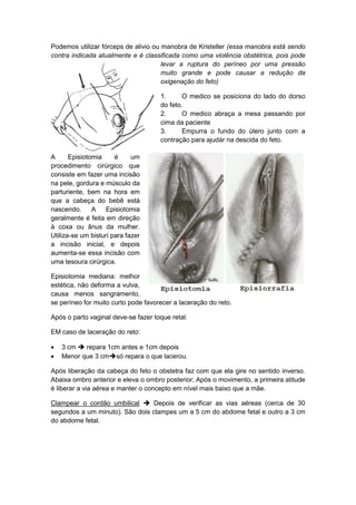 Podemos utilizar fórceps de alivio ou manobra de Kristeller (essa manobra está sendo
contra indicada atualmente e é classificada como uma violência obstétrica, pois pode
levar a ruptura do períneo por uma pressão
muito grande e pode causar a redução da
oxigenação do feto)
1. O medico se posiciona do lado do dorso
do feto.
2. O medico abraça a mesa passando por
cima da paciente
3. Empurra o fundo do útero junto com a
contração para ajudár na descida do feto.
A Episiotomia é um
procedimento cirúrgico que
consiste em fazer uma incisão
na pele, gordura e músculo da
parturiente, bem na hora em
que a cabeça do bebê está
nascendo. A Episiotomia
geralmente é feita em direção
à coxa ou ânus da mulher.
Utiliza-se um bisturi para fazer
a incisão inicial, e depois
aumenta-se essa incisão com
uma tesoura cirúrgica.
Episiotomia mediana: melhor
estética, não deforma a vulva,
causa menos sangramento,
se períneo for muito curto pode favorecer a laceração do reto.
Após o parto vaginal deve-se fazer toque retal.
EM caso de laceração do reto:
 3 cm  repara 1cm antes e 1cm depois
 Menor que 3 cmsó repara o que lacerou.
Após liberação da cabeça do feto o obstetra faz com que ela gire no sentido inverso.
Abaixa ombro anterior e eleva o ombro posterior; Após o movimento, a primeira atitude
é liberar a via aérea e manter o concepto em nível mais baixo que a mãe.
Clampear o cordão umbilical  Depois de verificar as vias aéreas (cerca de 30
segundos a um minuto). São dois clampes um a 5 cm do abdome fetal e outro a 3 cm
do abdome fetal.
 