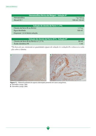 Caderno de Referência 3
• • • • • • • • • • • • • • • • • • •
30
Hematoxilina férrica de Weigert - Solução A*
Hematoxilina
Álcool 95 º
1 g / 0,5 g
100 ml / 50 ml
Solução de cloreto de Ferro 29 % - Solução B*
Cloreto de ferro III ou férrico a 1,17 %
Ácido clorídrico PA
99 ml
1 ml
*Na hora do uso, misturam-se quantidades iguais de solução A e solução B e coloca-se a solu-
ção sobre a lâmina.
Figura 11 - Material amiloide de aspecto alaranjado presente em vasos sanguíneos.
a - Vermelho-congo, 100x.
b - Vermelho-congo, 200x.
b
a
Solução de cloreto de Ferro 1,17%
Cloreto de ferro III ou férrico
Água destilada
1,17 g
100 ml
Desprezar 1,0 ml desta solução.
3.indd 30 11/08/12 20:30
 