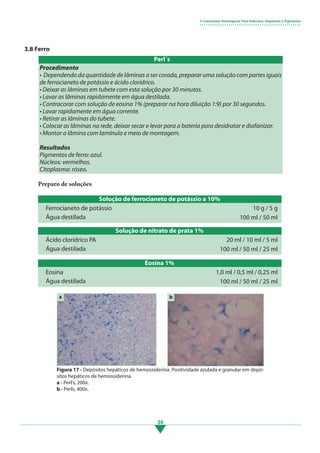 39
3.8 Ferro
Procedimento
• Dependendo da quantidade de lâminas a ser corada, preparar uma solução com partes iguais
de ferrocianeto de potássio e ácido clorídrico.
• Deixar as lâminas em tubete com esta solução por 30 minutos.
• Lavar as lâminas rapidamente em água destilada.
• Contracorar com solução de eosina 1% (preparar na hora diluição 1:9) por 30 segundos.
• Lavar rapidamente em água corrente.
• Retirar as lâminas do tubete.
• Colocar as lâminas na rede, deixar secar e levar para a bateria para desidratar e diafanizar.
• Montar a lâmina com lamínula e meio de montagem.
Resultados
Pigmentos de ferro: azul.
Núcleos: vermelhos.
Citoplasma: róseo.
Solução de ferrocianeto de potássio a 10%
Solução de nitrato de prata 1%
Eosina 1%
Ferrocianeto de potássio
Ácido clorídrico PA
Eosina
Água destilada
Água destilada
Água destilada
10 g / 5 g
20 ml / 10 ml / 5 ml
1,0 ml / 0,5 ml / 0,25 ml
100 ml / 50 ml
100 ml / 50 ml / 25 ml
100 ml / 50 ml / 25 ml
Preparo de soluções
Figura 17 - Depósitos hepáticos de hemossiderina. Positividade azulada e granular em depó-
sitos hepáticos de hemossiderina.
a - Perl’s, 200x.
b - Perls, 400x.
a b
3 Colorações Histológicas Para Grânulos, Depósitos e Pigmentos
• • • • • • • • • • • • • • • • • • • • • • • • • • • • • • • • • • • • • • • • • • • • • • • • •
Perl´s
3.indd 39 11/08/12 20:30
 