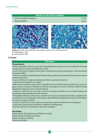 Caderno de Referência 3
• • • • • • • • • • • • • • • • • • •
56
5.3 Lepra
Solução uso de azul de metileno
Azul de metileno estoque
Água destilada
10 ml
90 ml
Figura 21 - Bacilos avermelhados, intracelulares, presentes em tecido pulmonar.
a - Ziehl-Neelsen, 200x.
b - Ziehl-Neelsen, 400x.
Procedimento
• Nesta coloração, as lâminas não são desparafinizadas no xilol, e sim na terebentina. O tempo
de exposição é o mesmo utilizado para o xilol.
• Lavar as lâminas em água corrente para retirada do excesso de terebentina. Secar as lâminas
em papel de filtro.
•ColocarasoluçãodeZiehl-Neelsenfiltradasobreaslâminasedeixarde40minutosaumahora
aproximadamente.
• Lavar as lâminas em água corrente para retirar o excesso do corante.
• Colocar álcool-ácido em um tubete.
• Diferenciar as lâminas, uma u uma, mergulhando-as em álcool-ácido e lavando em cuba com
água corrente, até que se obtenha um tom de rosa-pálido nos cortes. Observar a diferenciação
atentamente para que não se descore demais.
• Colocar as lâminas em uma rede e lavá-las em água corrente em uma cuba (embaixo da
torneira) por aproximadamente dez minutos.
• Mergulharaslâminas,umaauma,notubetecomsoluçãousodeazuldemetileno,rapidamente,
cercadedoisoutrêsmergulhosintercalados,dependendodavalidadedocorante,comlavagens
em cuba com água corrente.
• Colocar as lâminas na rede e deixar secar bem para que não desbotem na montagem.
• Levar para a bateria para desidratar e diafanizar rapidamente.
• Montar a lâmina com lamínula e meio de montagem.
Resultados
Bacilos Álcool-Ácido Resistentes (BAAR): vermelhos.
Filamentos de nocárdia: vermelhos.
Bacilos de lepra: vermelhos.
Fundo: azul-pálido.
Fite-faraco
a b
3.indd 56 11/08/12 20:30
 