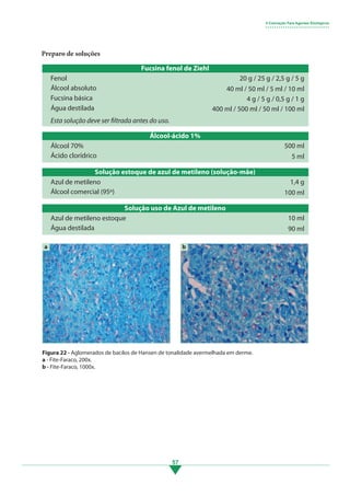 57
Preparo de soluções
Álcool-ácido 1%
Álcool 70%
Ácido clorídrico
500 ml
5 ml
Solução estoque de azul de metileno (solução-mãe)
Azul de metileno
Álcool comercial (95º)
1,4 g
100 ml
Solução uso de Azul de metileno
Azul de metileno estoque
Água destilada
10 ml
90 ml
5 Coloração Para Agentes Etiológicos
• • • • • • • • • • • • • • • • • • • • • • • • • • • • •
Fucsina fenol de Ziehl
Fenol
Álcool absoluto
Fucsina básica
Água destilada
20 g / 25 g / 2,5 g / 5 g
40 ml / 50 ml / 5 ml / 10 ml
4 g / 5 g / 0,5 g / 1 g
400 ml / 500 ml / 50 ml / 100 ml
Esta solução deve ser filtrada antes do uso.
Figura 22 - Aglomerados de bacilos de Hansen de tonalidade avermelhada em derme.
a - Fite-Faraco, 200x.
b - Fite-Faraco, 1000x.
a b
3.indd 57 11/08/12 20:30
 
