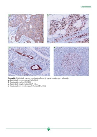71
	
  
	
  
a
	
  
b
	
  
d
c
Figura 26 - Positividade marrom em células malignas da mama, em pâncreas e linfonodo.
a - Positividade em membrana (C-erb, 100x).
b - Positividade nuclear (RE, 100x).
c - Positividade citoplasmática. (CK-7, 100x).
d - Positividade em membrana de linfócitos (CD3, 100x).
7 Imuno-histoquímica
• • • • • • • • • • • • • • • • •
3.indd 71 11/08/12 20:30
 