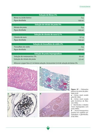 81
Solução de Bórax 5%
Bórax ou ácido bórico
Água destilada
5 g
100 ml
Solução de nitrato de prata 5%
Nitrato de prata
Água destilada
5 g
100 ml
Solução de cloreto de ouro 0,1%
Cloreto de ouro
Água destilada
0,1 g
100 ml
Solução de tiossulfato de sódio 2%
Tiossulfato de sódio
Água destilada
2 g
100 ml
Figura 27 - Colorações
básicas na rotina de pato-
logia renal.
a - Córtex renal corado
pela HE (100x).
b - Córtex renal corado
pelo tricrômico de Mas-
son (100x).
c - Glomérulos e túbulos
renais impregnados com
prata (400x).
d - Imuno-histoquímica
positiva em capilares pe-
ritubulares e glomérulos.
(C4d,100x).
Solução de prata impregnadora
Solução de metanamina 3%
Solução de nitrato de prata
50 ml
2,5 ml
Misturar e jogar fora 2,5 ml desta solução. Acrescentar 6 ml de solução de bórax 5%.
	
  
a b
d
c
9 Protocolos Especiais
• • • • • • • • • • • • • • • • • •
3.indd 81 11/08/12 20:31
 
