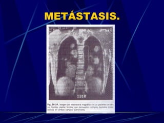 METÁSTASIS. 