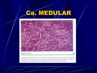 Ca. MEDULAR 