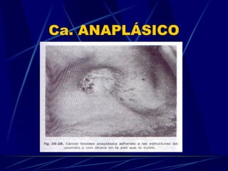 Ca. ANAPLÁSICO 