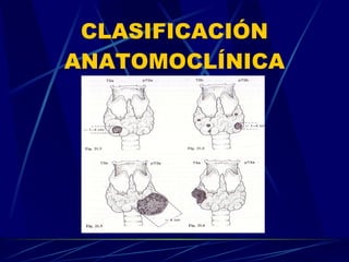 CLASIFICACIÓN ANATOMOCLÍNICA 