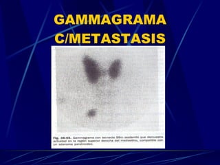 GAMMAGRAMA C/METASTASIS 