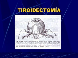 TIROIDECTOMÍA 