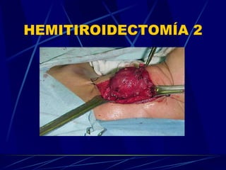 HEMITIROIDECTOMÍA 2 