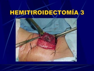 HEMITIROIDECTOMÍA 3 
