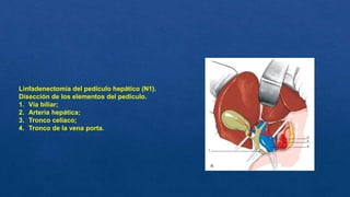 Linfadenectomía del pedículo hepático (N1).
Disección de los elementos del pedículo.
1. Vía biliar;
2. Arteria hepática;
3. Tronco celíaco;
4. Tronco de la vena porta.
 