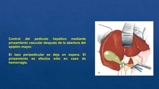 Control del pedículo hepático mediante
pinzamiento vascular después de la abertura del
epiplón mayor.
El lazo peripedicular se deja en espera. El
pinzamiento se efectúa sólo en caso de
hemorragia.
 
