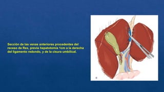 Sección de las venas anteriores procedentes del
receso de Rex, previa hepatotomía 1cm a la derecha
del ligamento redondo, y de la cisura umbilical.
 