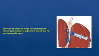 Inyección de carmín de índigo en una rama portal
anterior para delimitar el segmento 4 anterior que ha
sido desvascularizado.
 