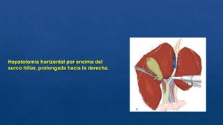Hepatotomía horizontal por encima del
surco hiliar, prolongada hacia la derecha.
 