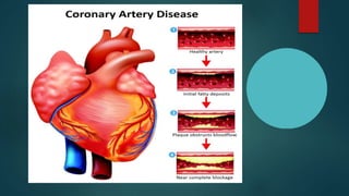 Coronary artery disease or Ischemic heart disease | PPTX