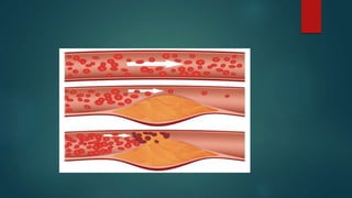 coronary artery disease | PPTX