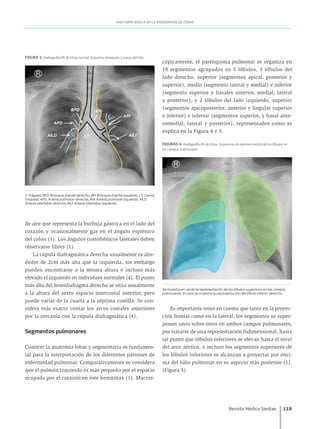 Revista Médica Sanitas	 119
ANATOMÍA BÁSICA EN LA RADIOGRAFÍA DE TÓRAX
de aire que representa la burbuja gástrica en el lado del
corazón y ocasionalmente gas en el ángulo esplénico
del colon (1). Los ángulos costofrénicos laterales deben
observarse libres (1).
La cúpula diafragmática derecha usualmente es alre-
dedor de 2cm más alta que la izquierda, sin embargo
pueden encontrarse a la misma altura e incluso más
elevado el izquierdo en individuos normales (4). El punto
más alto del hemidiafragma derecho se sitúa usualmente
a la altura del sexto espacio intercostal anterior, pero
puede variar de la cuarta a la séptima costilla. Se con-
sidera más exacto contar los arcos costales anteriores
por la cercanía con la cúpula diafragmática (4).
Segmentos pulmonares
Conocer la anatomía lobar y segmentaria es fundamen-
tal para la interpretación de los diferentes patrones de
enfermedad pulmonar. Comparativamente se considera
que el pulmón izquierdo es más pequeño por el espacio
ocupado por el corazón en éste hemitórax (1). Macros-
cópicamente, el parénquima pulmonar se organiza en
18 segmentos agrupados en 5 lóbulos, 3 lóbulos del
lado derecho, superior (segmentos apical, posterior y
superior), medio (segmento lateral y medial) e inferior
(segmento superior y basales anterior, medial, lateral
y posterior), y 2 lóbulos del lado izquierdo, superior
(segmentos apicoposterior, anterior y lingular superior
e inferior) e inferior (segmentos superior, y basal ante-
romedial, lateral y posterior), representados como se
explica en la Figura 4 y 5.
FIGURAS 4. Radiografía PA de tórax. Esquemas de representación de los lóbulos en
los campos pulmonares
Se muestra en verde la representación de los lóbulos superiores en los campos
pulmonares. En azul se muestra la representación del lóbulo inferior derecho.
Es importante tener en cuenta que tanto en la proyec-
ción frontal como en la lateral, los segmentos se super-
ponen unos sobre otros en ambos campos pulmonares,
por tratarse de una representación bidimensional, hasta
tal punto que lóbulos inferiores se elevan hasta el nivel
del arco aórtico, e incluso los segmentos superiores de
los lóbulos inferiores se alcanzan a proyectar por enci-
ma del hilio pulmonar en su aspecto más posterior (1).
(Figura 5)
FIGURA 3. Radiografía PA de tórax normal. Esquema bronquios y vasos del hilio
T: Tráquea, BFD: Bronquio fuente derecho, BFI: Bronquio fuente izquierdo, CT: Carina
traqueal, APD: Arteria pulmonar derecha, API: Arteria pulmonar izquierda, AILD:
Arteria interlobar derecha, AILI: Arteria interlobar izquierda.
 