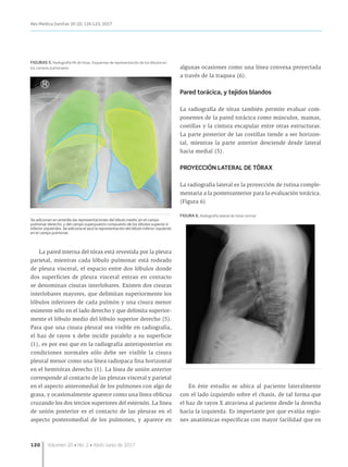 120	 Volumen 20 • No. 2 • Abril/Junio de 2017
Rev.Medica.Sanitas 20 (2): 116-123, 2017
La pared interna del tórax está revestida por la pleura
parietal, mientras cada lóbulo pulmonar está rodeado
de pleura visceral, el espacio entre dos lóbulos donde
dos superficies de pleura visceral entran en contacto
se denominan cisuras interlobares. Existen dos cisuras
interlobares mayores, que delimitan superiormente los
lóbulos inferiores de cada pulmón y una cisura menor
existente sólo en el lado derecho y que delimita superior-
mente el lóbulo medio del lóbulo superior derecho (5).
Para que una cisura pleural sea visible en radiografía,
el haz de rayos x debe incidir paralelo a su superficie
(1), es por eso que en la radiografía anteroposterior en
condiciones normales sólo debe ser visible la cisura
pleural menor como una línea radiopaca fina horizontal
en el hemitórax derecho (1). La línea de unión anterior
corresponde al contacto de las pleuras visceral y parietal
en el aspecto anteromedial de los pulmones con algo de
grasa, y ocasionalmente aparece como una línea oblicua
cruzando los dos tercios superiores del esternón. La línea
de unión posterior es el contacto de las pleuras en el
aspecto posteromedial de los pulmones, y aparece en
algunas ocasiones como una línea convexa proyectada
a través de la traquea (6).
Pared torácica, y tejidos blandos
La radiografía de tórax también permite evaluar com-
ponentes de la pared torácica como músculos, mamas,
costillas y la cintura escapular entre otras estructuras.
La parte posterior de las costillas tiende a ser horizon-
tal, mientras la parte anterior desciende desde lateral
hacia medial (5).
PROYECCIÓN LATERAL DE TÓRAX
La radiografía lateral es la proyección de rutina comple-
mentaria a la posteroanterior para la evaluación torácica.
(Figura 6)
FIGURA 6. Radiografía lateral de tórax normal
En éste estudio se ubica al paciente lateralmente
con el lado izquierdo sobre el chasis, de tal forma que
el haz de rayos X atraviesa al paciente desde la derecha
hacia la izquierda. Es importante por que evalúa regio-
nes anatómicas específicas con mayor facilidad que en
FIGURAS 5. Radiografía PA de tórax. Esquemas de representación de los lóbulos en
los campos pulmonares
Se adicionan en amarillo las representaciones del lóbulo medio, en el campo
pulmonar derecho, y del campo superpuesto compuesto de los lóbulos superior e
inferior izquierdos. Se adiciona el azul la representación del lóbulo inferior izquierdo
en el campo pulmonar.
 