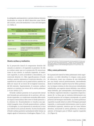 Revista Médica Sanitas	 121
ANATOMÍA BÁSICA EN LA RADIOGRAFÍA DE TÓRAX
la radiografía anteroposterior y permite detectar lesiones
localizadas en zonas de difícil detección como detrás
del corazón, cerca del mediastino o cerca del diafragma
(1) (Tabla 2)
TABLA 2. ESTRUCTURAS QUE DEBEN VALORARSE EN LA
RADIOGRAFÍA LATERAL DE TÓRAX (5)
Región Lo que debe verse
Espacio retroesternal
Espacio radiolúcido en forma de media luna
entre esternón y aorta ascendente
Región hiliar Ausencia de masa bien definida
Cisuras
Deben verse como líneas delgadas, como
trazadas con un lápiz
Columna dorsal
Cuerpos rectangulares con platillos
paralelos, espacios intervertebrales
conservados
Diafragma y senos
costofrénicos
Diafragma derecho ligeramente arriba del
izquierdo, senos costofrénicos posteriores
agudos y bien definidos
Silueta cardiaca y mediastino
En la proyección lateral el componente derecho del
corazón es anterior y el izquierdo es posterior. En ella
se evalúan mejor que en la proyección PA estructuras
como el arco aórtico, la aurícula izquierda, el ventrí-
culo izquierdo, la aorta ascendente y descendente, y el
ventrículo derecho (1). Más específicamente el borde
cardiaco anterior representa el ventrículo derecho, y la
superficie en contacto con la pared torácica anterior no
debe ser mayor de un tercio de la longitud craneocau-
dal del esternón. Superiormente, el contorno cardiaco
anterior se continúa con tronco de la arteria pulmonar
y el arco aórtico (2,7).
El borde cardiaco posterior en la proyección lateral
está formado por protrusiones de la aurícula y del ven-
trículo izquierdos, en condiciones normales debe existir
un espacio retrocardiaco libre entre el borde posterior y
la columna (2). Ocasionalmente se visualiza una opa-
cidad triangular entre el borde posteroinferior cardiaco
y el diafragma, la cual representa la entrada de la vena
cava inferior en la aurícula derecha. En ésta localización
el borde cardiaco posterior normalmente debe formar un
ángulo agudo al intersectar el diafragma (Figura 7) (2).
FIGURA 7. Radiografía lateral de tórax normal. Esquema de estructuras principales
VD: Ventrículo derecho, VI: Ventrículo izquierdo, Aurícula izquierda, VCI: Vena cava
inferior, TAP: Tronco de la arteria pulmonar, T: Tráquea, AA: Aorta ascendente, AD:
Aorta descendente, E: Escapulas, BLSI: Bronquio lobar superior izquierdo, HDD:
Hemidiafragma derecho, HDI: Hemidiafragma izquierdo, cm: Cisura menor, cmy:
Cisura mayor.
Hilio y vasos pulmonares
En la proyección lateral los hilios pulmonares están super-
puestos y se debe identificar la tráquea como punto
de referencia, como una columna de aire delimitada
por una banda vertical posteriormente, descendiendo
desde el mediastino superior hacia los hilios pulmona-
res; la tráquea termina en dos estructuras redondeadas
radiolúcidas, una superior menos definida y una inferior
mejor definida, que corresponden a los bronquios para
los lóbulos superiores derecho e izquierdos respectiva-
mente (8). La línea que se continúa inferiormente con
la pared posterior de la tráquea corresponde a la pared
posterior del bronquio intermedio. La arteria pulmonar
izquierda se puede observar sobre el bronquio principal
izquierdo, y continuando inferiormente como la arteria
interlobular izquierda, mientras que los vasos hiliares
derechos, incluyendo la arteria pulmonar, se observan
anterior al bronquio para el lóbulo superior izquierdo
(3) (Figura 8)
 