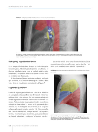 122	 Volumen 20 • No. 2 • Abril/Junio de 2017
Rev.Medica.Sanitas 20 (2): 116-123, 2017
Diafragma y ángulos costofrénicos
En la proyección lateral no siempre es fácil diferenciar
los diafragmas. El diafragma izquierdo usualmente se
dispone más bajo, suele verse la burbuja gástrica infe-
riormente, y su porción anterior se pierde cuando entra
en contacto con el corazón.
El ángulo costofrénico posterior es el más profundo
que el lateral, se ve sólo en la radiografía lateral y debe
verse libre en condiciones normales (1). (Figura 7)
Segmentos pulmonares
Como se explicó previamente las cisuras se observan
en radiografía sólo cuando el haz de rayos X está orien-
tado paralelo a las mismas. Por eso en una radiografía
lateral se pueden identificar las dos cisuras mayores y la
menor. Ambas cisuras mayores descienden como líneas
radiopacas finas desde la altura de la quinta vértebra
dorsal hasta el diafragma, donde terminan en un punto
próximo a la pared torácica anterior (1). Diferenciar las
dos cisuras mayores no siempre es fácil, la izquierda
termina en el diafragma izquierdo, que generalmente
se dispone más abajo y está sobre la burbuja gástrica.
La cisura menor tiene una orientación horizontal,
comienza posteriormente la cisura mayor derecha y ter-
mina en la pared torácica anterior (figura 9) (1).
FIGURA 9. Radiografía lateral de tórax. Representación de los lóbulos en los campos
pulmonares
Se muestra la representación del lóbulo superior derecho y segmentos
apicoposterior y anterior del izquierdo en amarillo. En azul la representación del
lóbulo medio y los segmentos lingulares. En rojo inferiormente, la representación
en el campo pulmonar de los lóbulos inferiores.
FIGURA 8. Radiografía lateral de tórax. Esquema con estructuras principales hiliares
Se observa la tráquea (morado) descendiendo del mediastino superior hasta llegar a los bronquios para el lóbulo superior derecho (BLSD) e
izquierdo (BLSI). La arteria pulmonar derecha (APD) se observa en relación anterior al BLSI y la arteria pulmonar en forma arqueada sobre el
mismo. El arco aórtico se muestra en rojo.
 