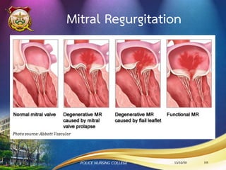 อาการและอาการแสดงของ AR
• หอบเหนื่อย โดยเฉพาะในท่านอนราบ
• หลอดเลือดที่คอเต้นแรงกว่าปกติ
13/10/59POLICE NURSING COLLEGE 105
 