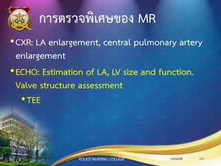 อาการและอาการแสดงของ MR
•อ่อนเพลีย
•Low cardiac output
•หอบเหนื่อยขณะออกกาลังกายหรือหอบในท่านอนราบ
•บวม หลอดเลือดที่คอโป่ง ตับโต
•อาจมีใจสั่นจาก AF
13/10/59POLICE NURSING COLLEGE 111
 