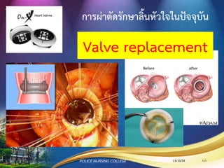 ตาแหน่งในการฟังเสียงหัวใจ
13/10/59POLICE NURSING COLLEGE 113
 