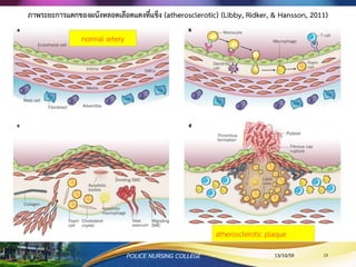 normal artery
atherosclerotic plaque
ภาพระยะการแตกของผนังหลอดเลือดแดงที่แข็ง (atherosclerotic) (Libby, Ridker, & Hansson, 2011)
13/10/59POLICE NURSING COLLEGE 13
 